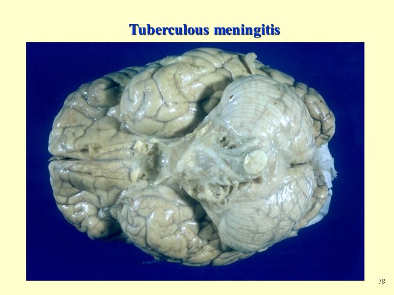 Tuberculous meningitis 38